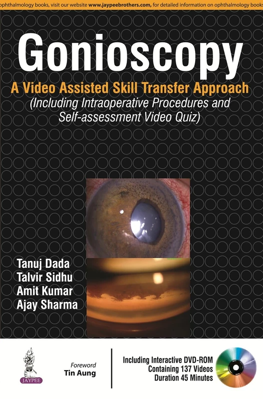 Gonioscopy: A Video Assisted Skill Transfer Approach