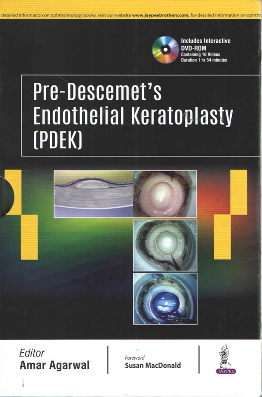 Pre-Descemet's Endothelial Keratoplasty (PDEK) - Image 1