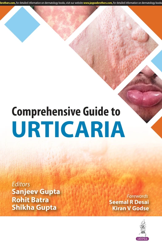 Comprehensive Guide to Urticaria - Image 1