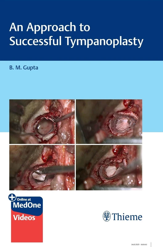 An Approach to Successful Tympanoplasty
