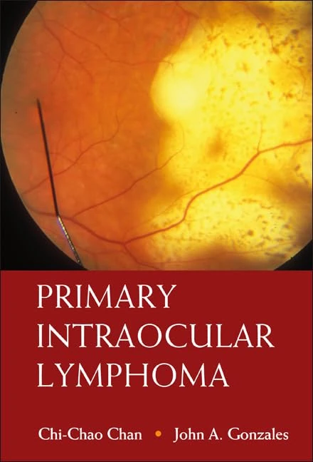 PRIMARY INTRAOCULAR LYMPHOMA