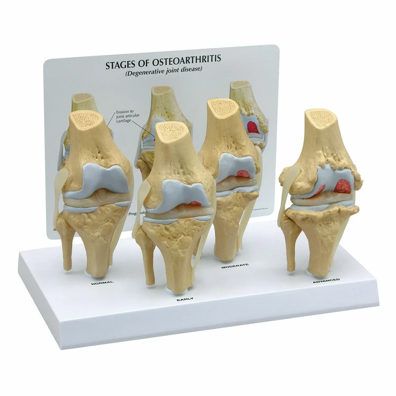 3B Scientific 4-Stage Osteo Knee Model Set