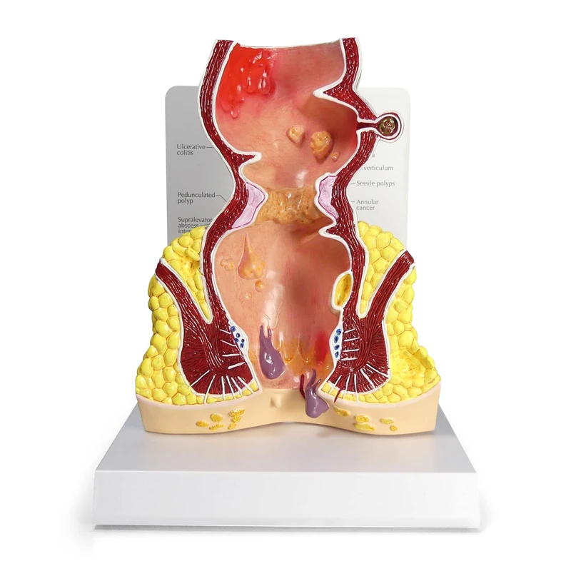3B Scientific Rectum cross section (oversize) with pathologies