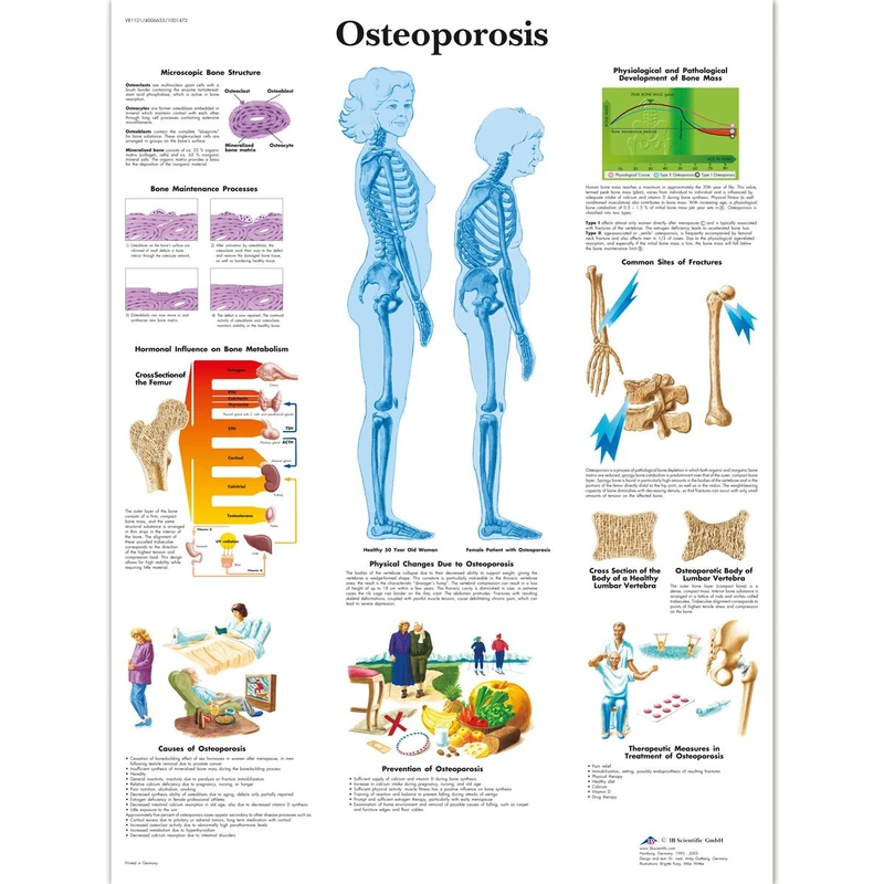 3B Scientific Human Anatomy - Osteoporosis Chart, Paper Version