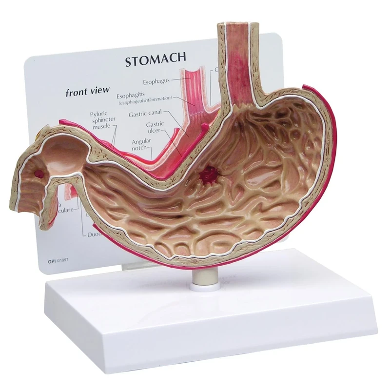 3B Scientific Stomach Model with Ulcers