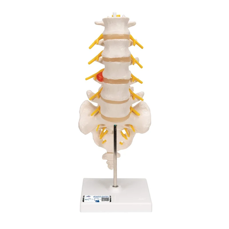 3B Scientific Lumbar Spinal Column with Dorso Lateral Prolapsed InterVertebral Disc + free anatomy software - 3B Smart Anatomy