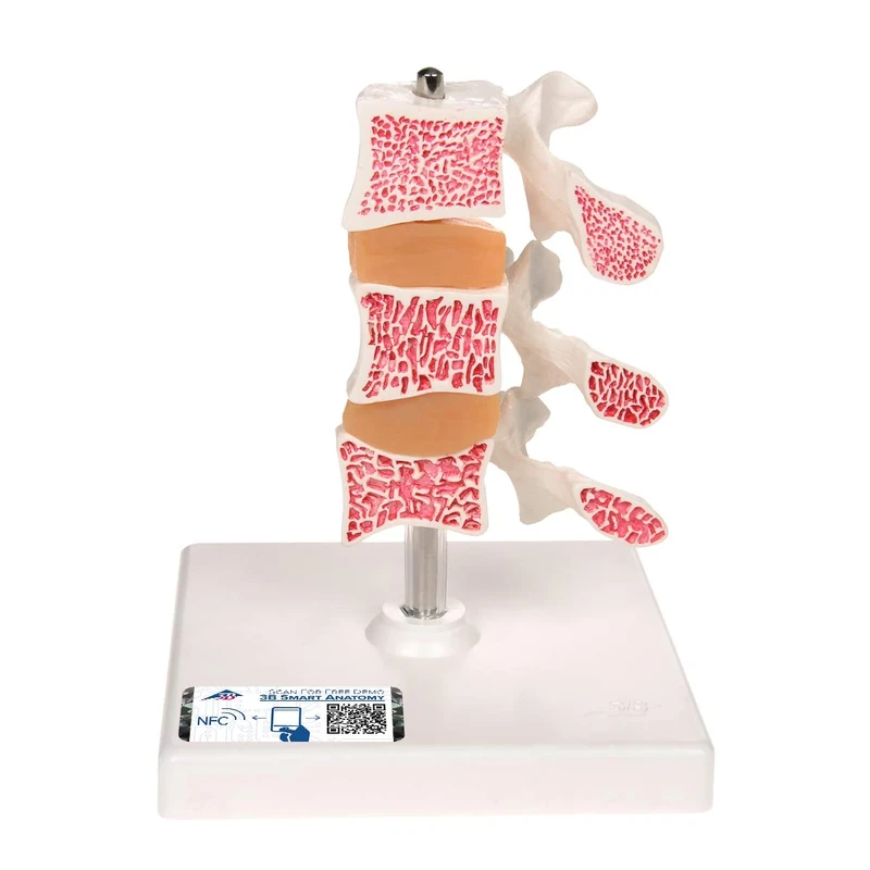 3B Scientific Deluxe Osteoporosis Model 3 Vertebrae + free Anatomy App - 3B Smart Anatomy