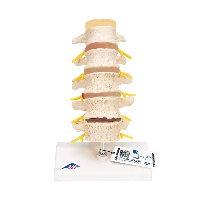 3B Scientific Stages of Disc prolapse and Vertebral Degeneration + free anatomy software - 3B Smart Anatomy A795
