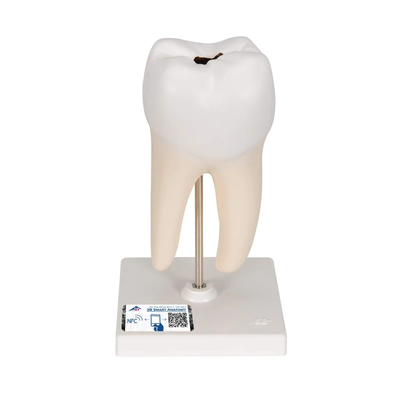 3B Scientific D10/4 Lower Twin-Root Molar Showing Cavities, 2 Part + free Anatomy App - 3B Smart Anatomy - Image 1