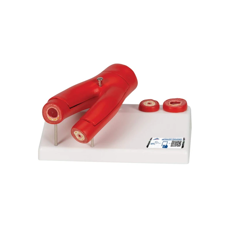 3B Scientific G40 Human Anatomy - Arteriosclerosis Model with Cross Section of Artery, 2 Part + free Anatomy App - 3B Smart Anatomy