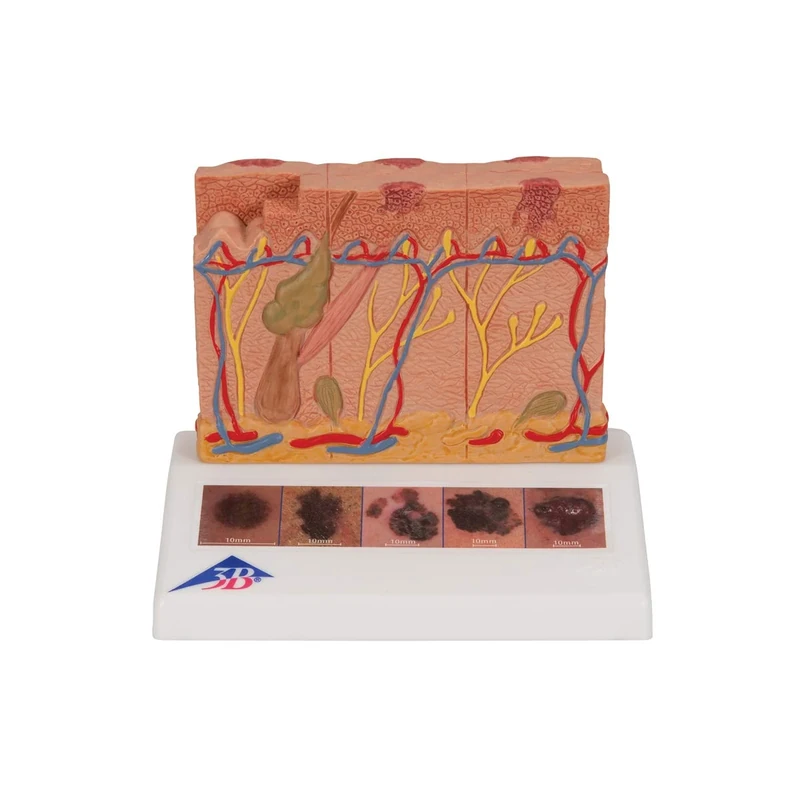 3B Scientific Skin Cancer Model + free Anatomy App - 3B Smart Anatomy