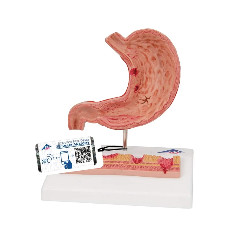 3B Scientific K17 Stomach With Ulcers + free Anatomy App - 3B Smart Anatomy