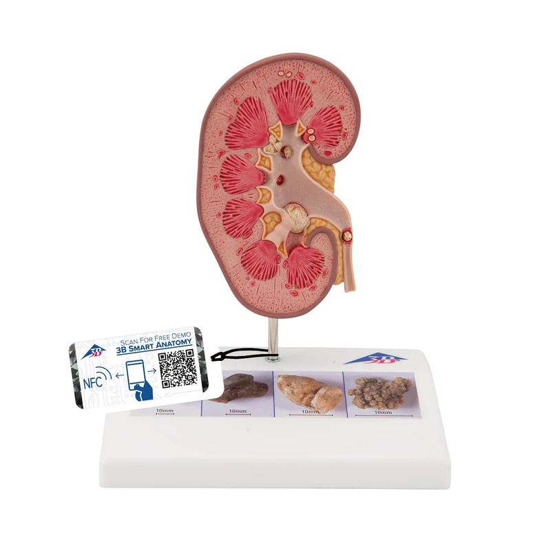 3B Scientific K29 Kidney Stone Model + free Anatomy App - 3B Smart Anatomy