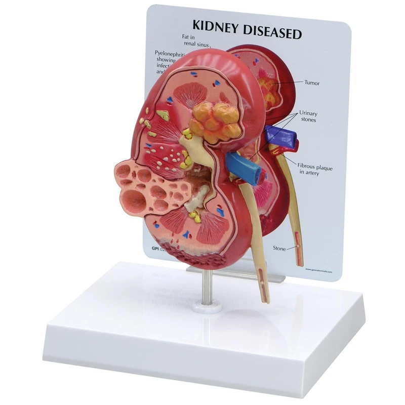 3B Scientific Diseased Kidney Model