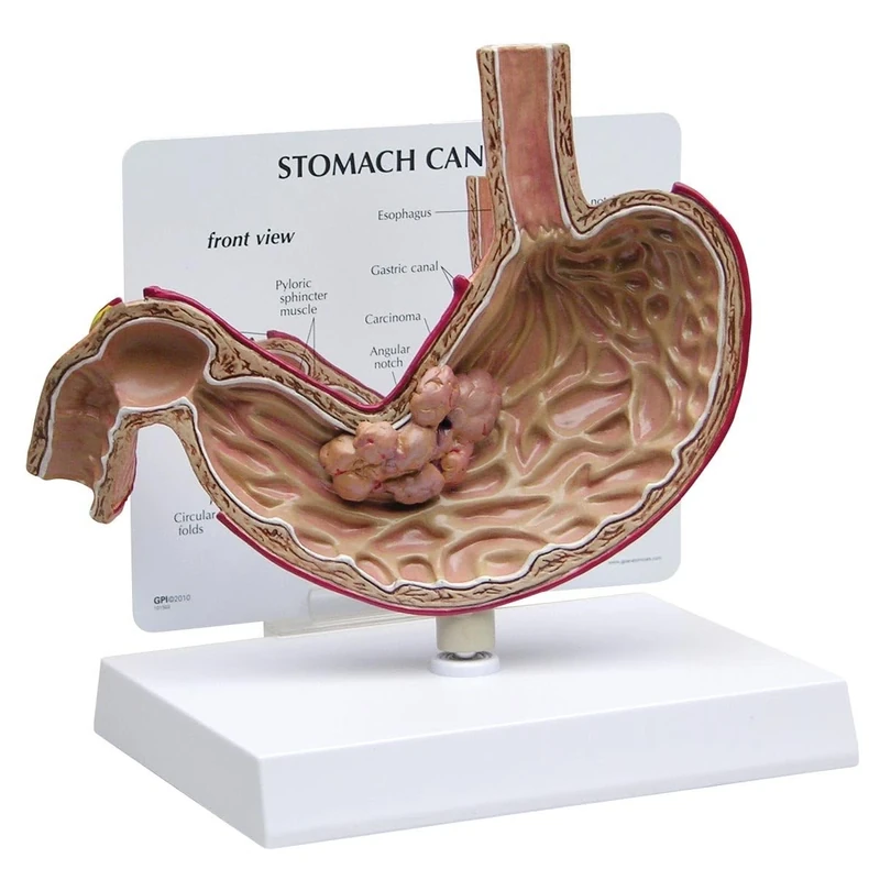 3B Scientific Stomach Cancer Model