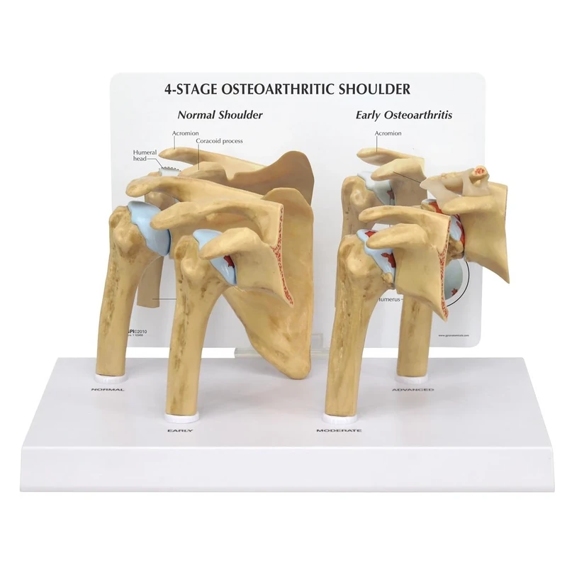 3B Scientific 4 Stage Osteoarthritis (OA) Shoulder Model