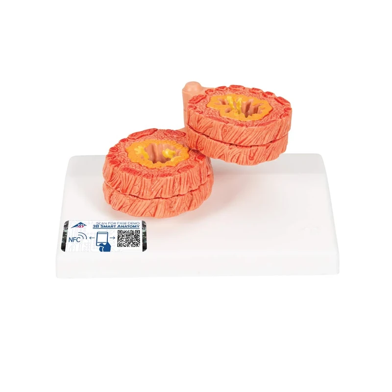 3B Scientific COPD Bronchial Tissue Model + free Anatomy App - 3B Smart Anatomy