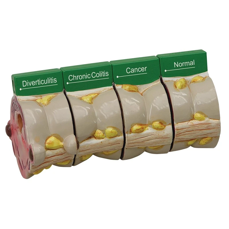 3B Scientific 4 Piece Colon with Pathologies