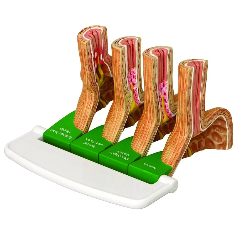 3B Scientific 1019525 Gastro Esophageal Reflux Disease Model, 4pcs