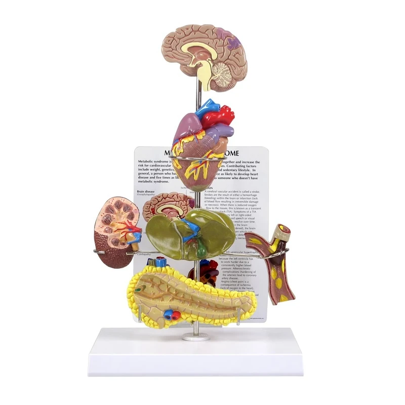3B Scientific Metabolic Syndrome Model