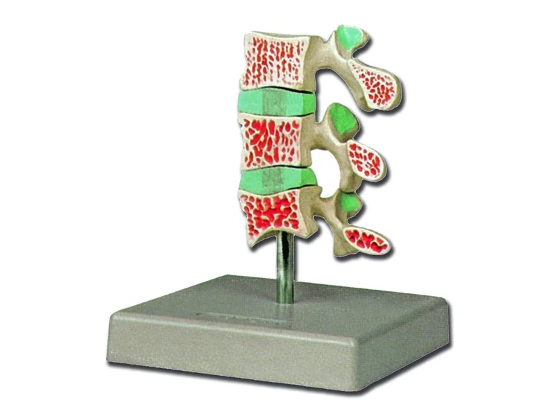 Gima - Anatomical Model of 3 Vertebrae with Advanced Osteoporosis, Highly Detailed, Magnification 1X