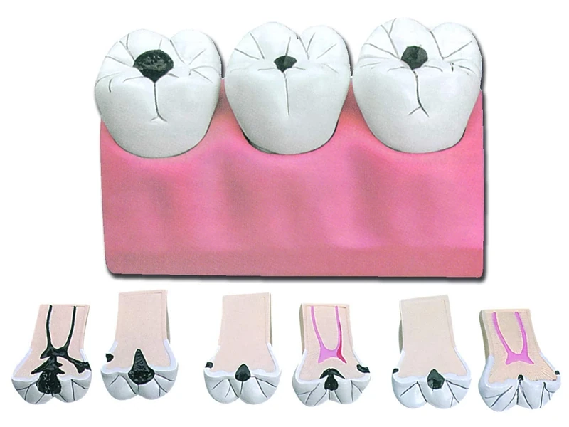 Gima - Anatomical Model of Dental Caries, Highly Detailed, Modular in 7 Parts, Magnification 4 X