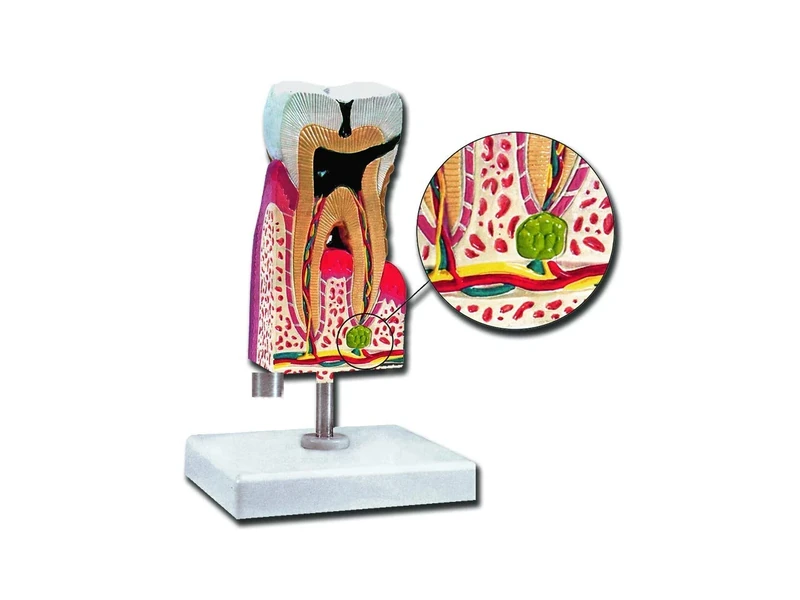 Gima - Anatomical Model of Lower Molar with Caries, Highly Detailed, Magnification 10 X