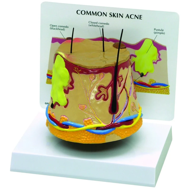 3B Scientific Skin Acne Model (oversize)
