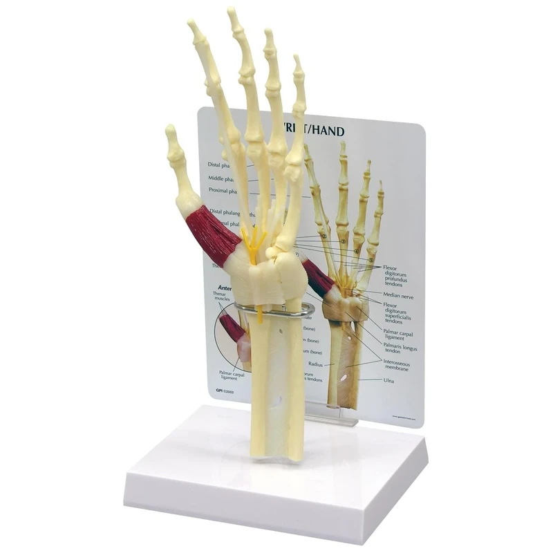 3B Scientific Hand/Wrist Carpal Tunnel Syndrome Model