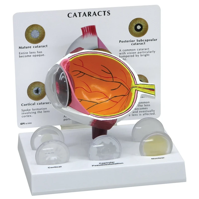 3B Scientific Cataract Eye