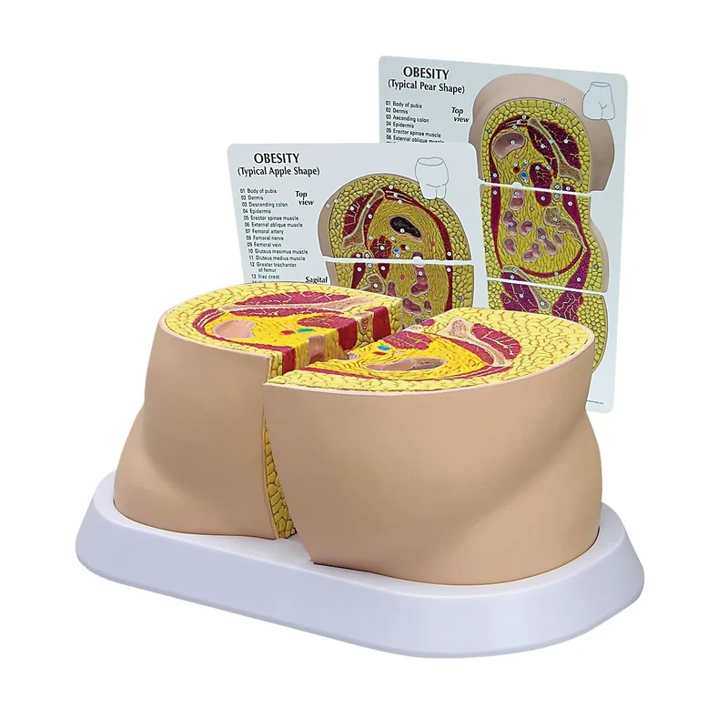 3B Scientific Obesity Model - Image 1