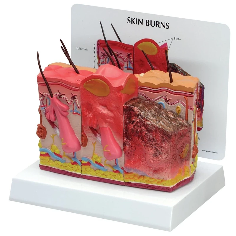 3B Scientific Skin Burn-Normal Skin Model
