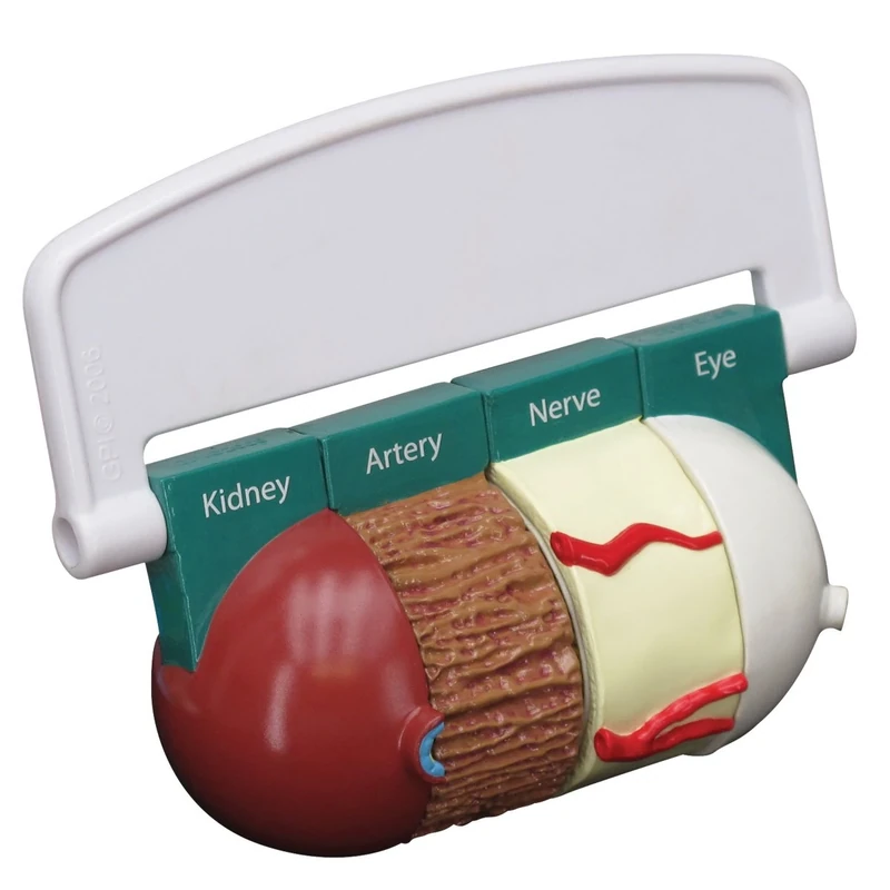 3B Scientific 4-Piece Diabetes Model