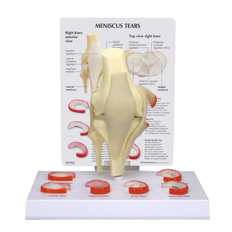 3B Scientific Meniscus Knee Model with 6 Tears