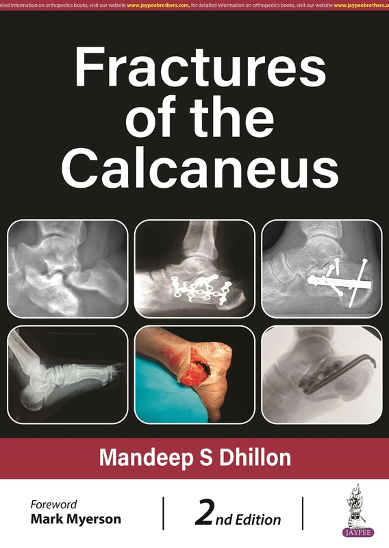 Fractures of the Calcaneus - Image 1