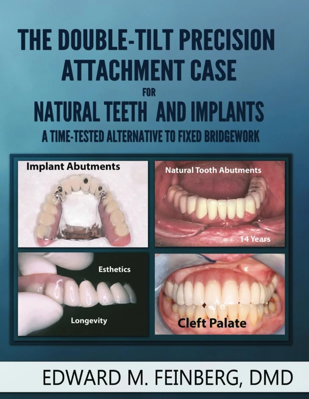 The Double-Tilt Precision Attachment Case for Natural Teeth and Implants