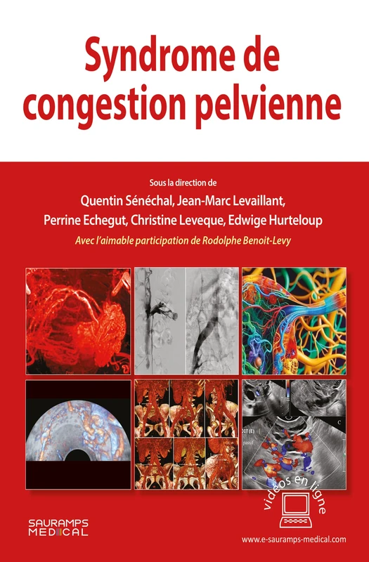 Syndrome de congestion pelvienne - Image 1