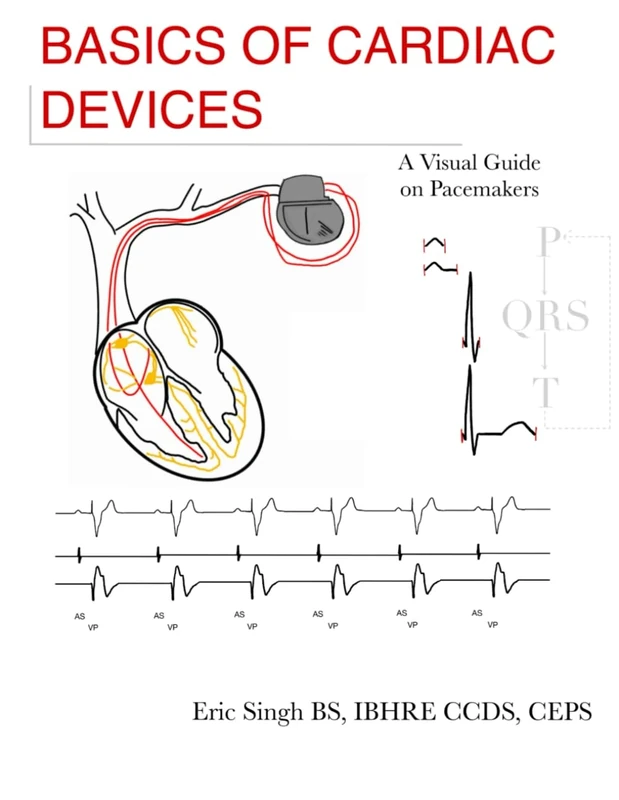 Basics of Cardiac Devices: A Visual Guide on Pacemakers