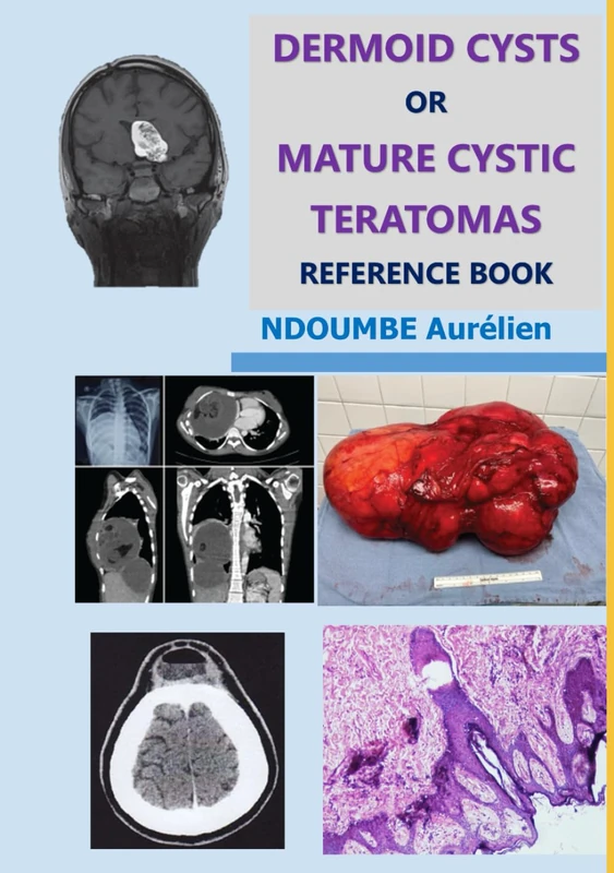 Dermoid Cysts or Mature Cystic Teratomas: Reference Book