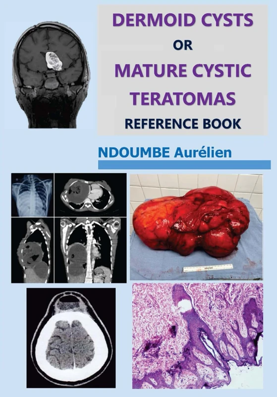 DERMOID CYSTS OR MATURE CYSTIC TERATOMAS: REFERENCE BOOK