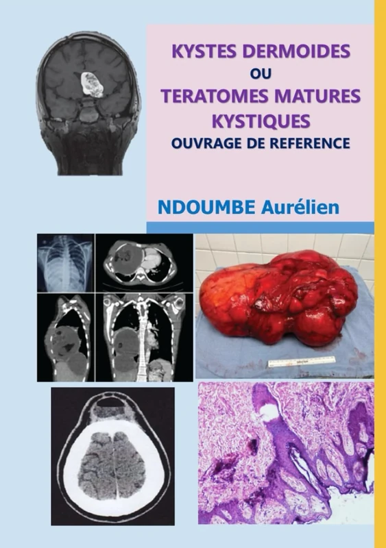 kystes dermoïdes ou tératomes matures kystiques -: ouvrage de référence
