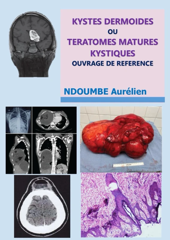 kystes dermoïdes ou tératomes matures kystiques -: ouvrage de référence